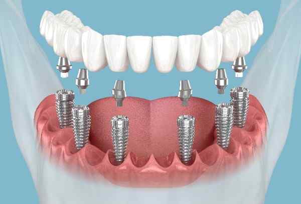 Trusted Local Dentists Offering Advanced Care Options