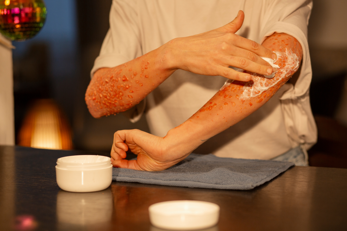 Eczema Rash Treatment & Get Relief with Teleurgent Care