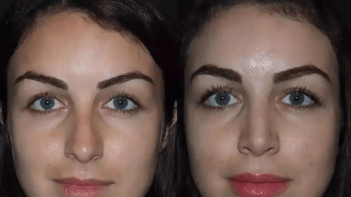 Meet the Best Doctors in Dubai for Rhinoplasty Before and After Success