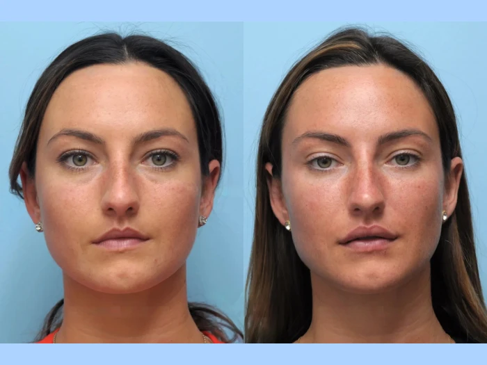 Lift and Glow: Best Doctors in Dubai for Thread Lift Treatments