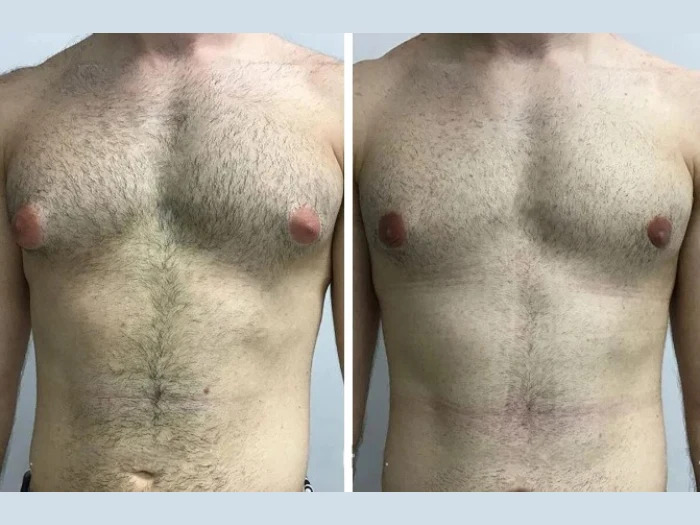 Gynecomastia Surgery in Dubai How Long Do Results Actually Last