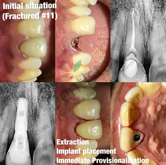 How to Maintain Healthy Dental Implants: Full Guide