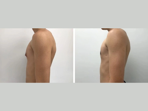 Best Gynecomastia Surgeon in Dubai