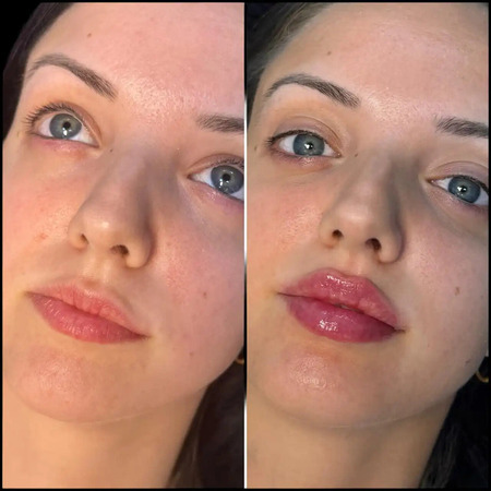 Fillers Treatment in Dubai: Before and After Transformations