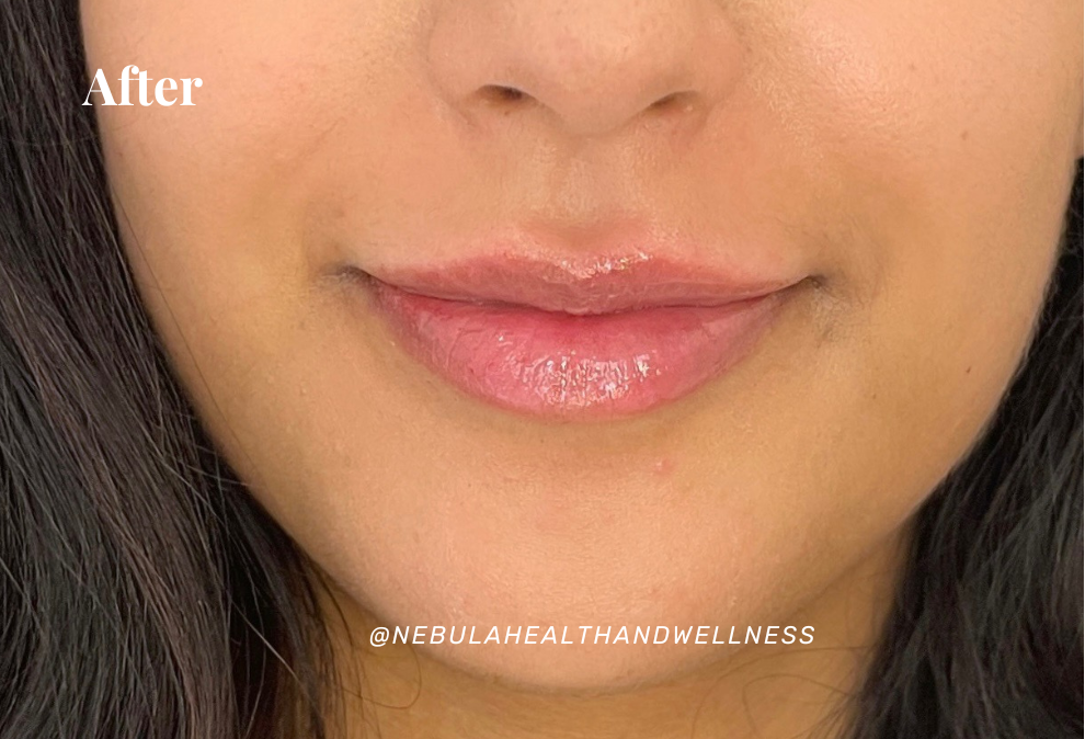 Essential Tips for First-Time Botox Users in Mississauga