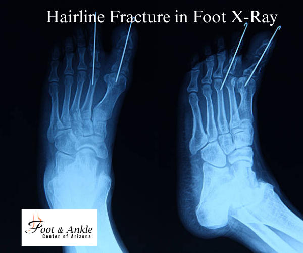 How to Identify a Hairline Fracture in the Foot from an X-Ray