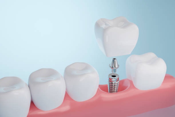 Why are dental implants best for tooth replacement