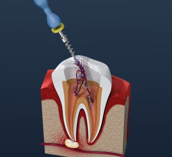 Does Root Canal Treatment Remove All Existing Tooth Fillings?